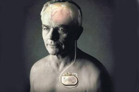 【健康解碼】起搏器真的能治好帕金森病嗎？